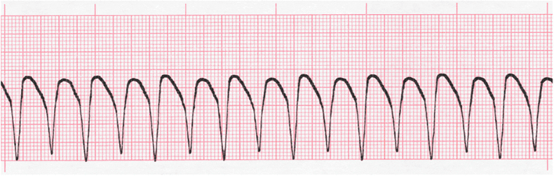 ecg rhythm strip for quiz