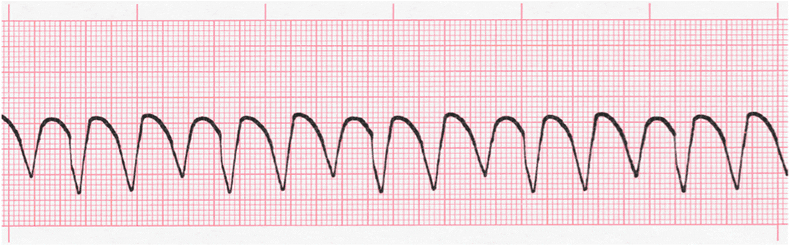 ecg rhythm strip for quiz