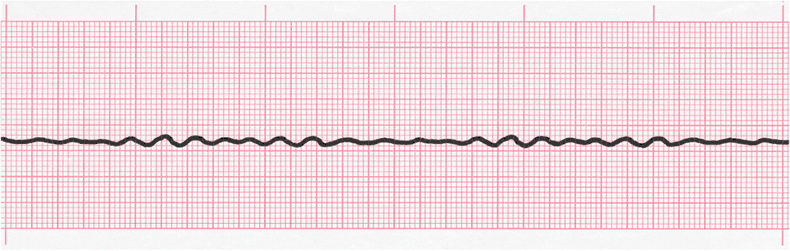 ecg rhythm strip for quiz