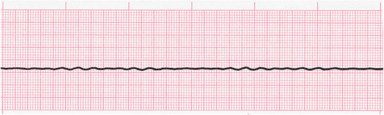 ecg rhythm strip for quiz