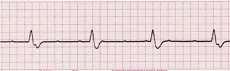 ecg rhythm strip for quiz