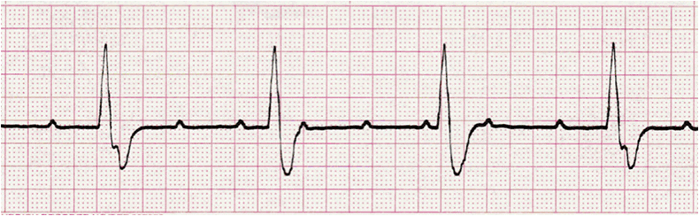ecg rhythm strip for quiz