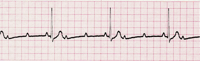 Essential EKGs for Nurses | Multiple Choice Graded Quiz