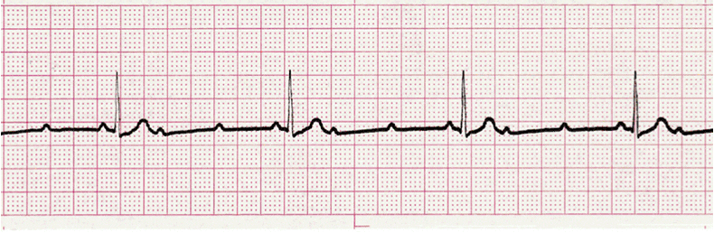 ecg rhythm strip for quiz