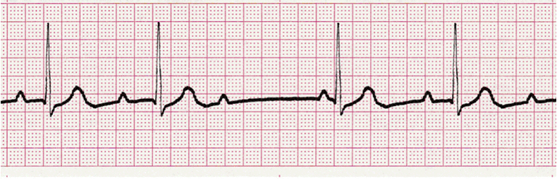 ecg rhythm strip for quiz