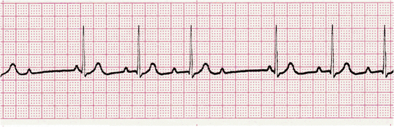 EKG Quiz for ACLS | Multiple Choice Graded Quiz