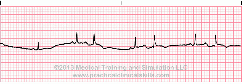 ecg rhythm strip for quiz