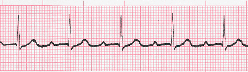 EKG Practice Drill