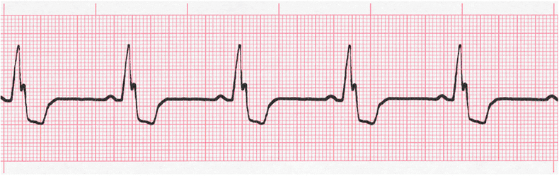 ecg rhythm strip for quiz