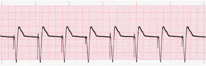 ecg rhythm strip for quiz