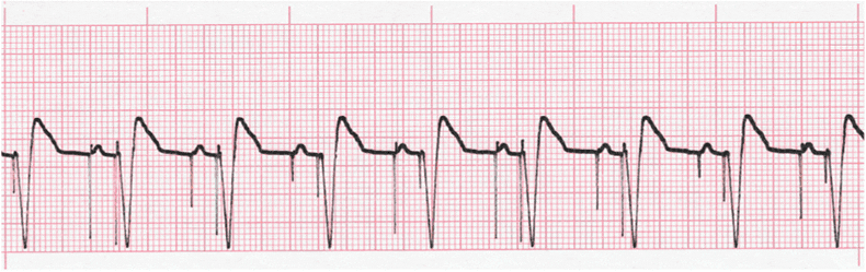 EKG Practice Drill