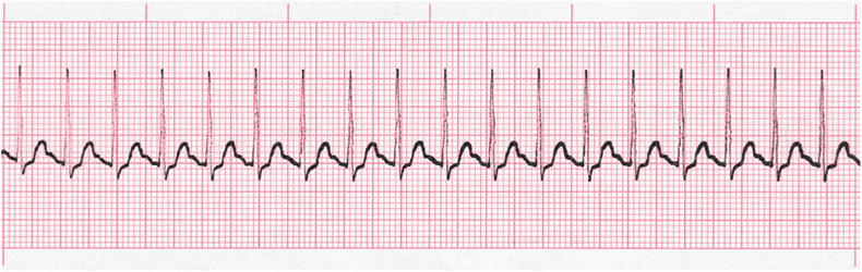 ecg rhythm strip for quiz