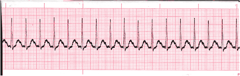 ecg rhythm strip for quiz