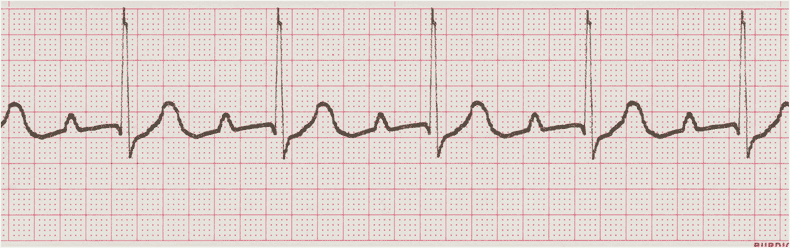 EKG - Estos ejercicios prácticos 