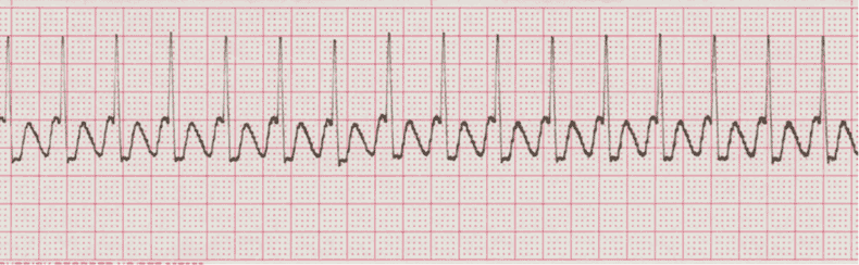 ecg rhythm strip for quiz