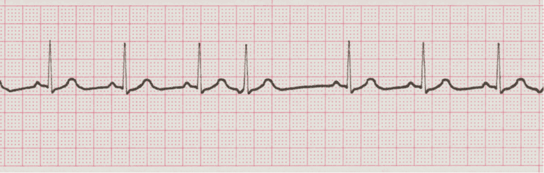 ecg rhythm strip for quiz