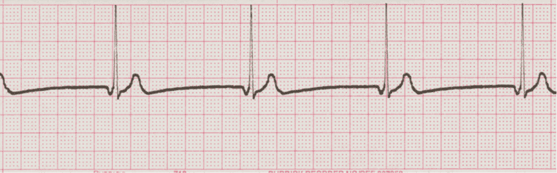 ecg rhythm strip for quiz