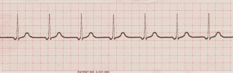 ecg rhythm strip for quiz