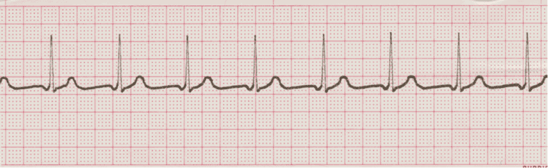 EKG Practice Drill