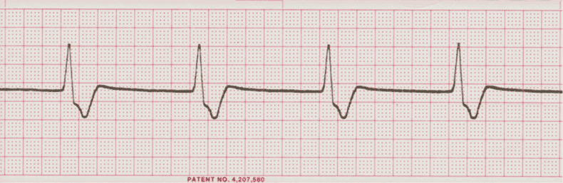 ecg rhythm strip for quiz