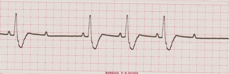 ecg rhythm strip for quiz