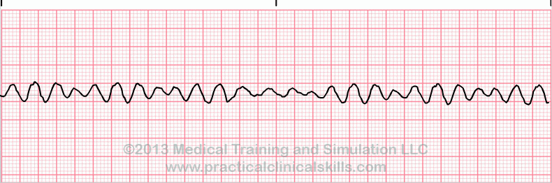 Ventricular Fibrillation ECG tracing