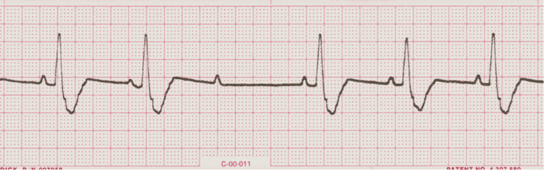 ecg rhythm strip for quiz