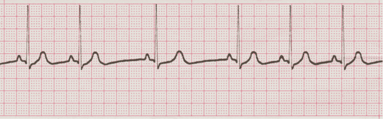 ecg rhythm strip for quiz