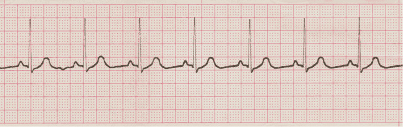 ecg rhythm strip for quiz