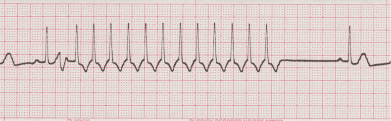 ecg rhythm strip for quiz