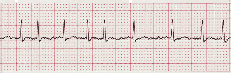 EKG - Identifizieren Sie die Aufzeichnung