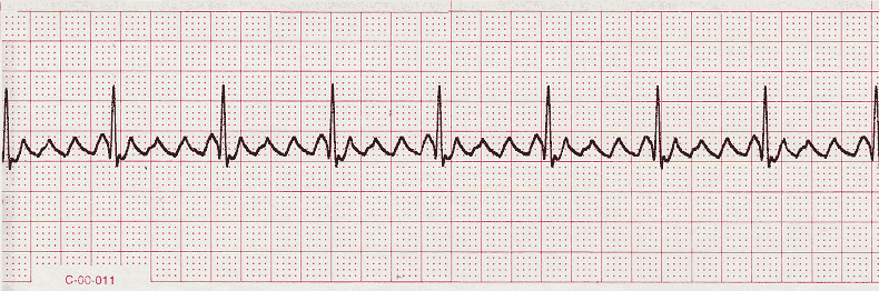 ECG Practice Drill