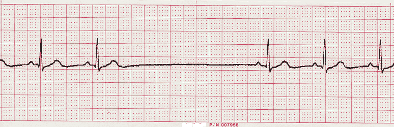 ecg rhythm strip for quiz