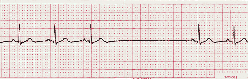 ecg rhythm strip for quiz