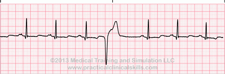 ECG Practice Drill