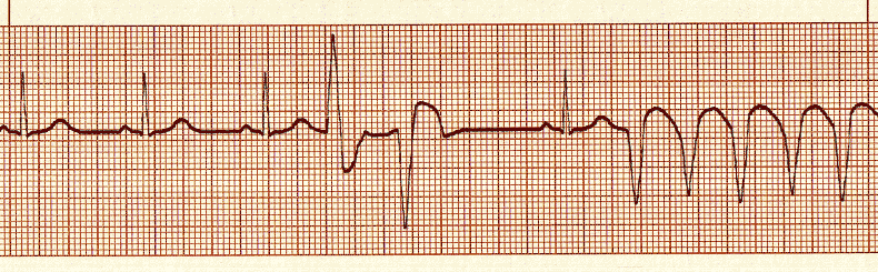 ecg rhythm strip for quiz
