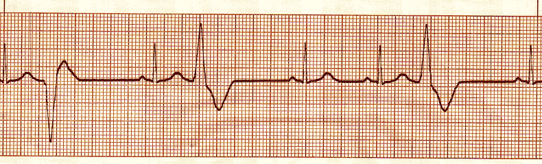 ecg rhythm strip for quiz