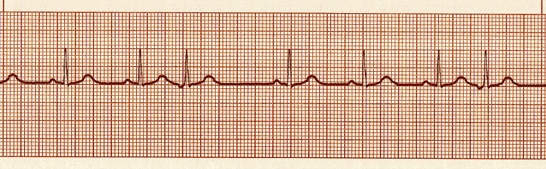 ecg rhythm strip for quiz