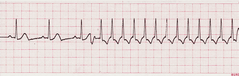 ecg rhythm strip for quiz