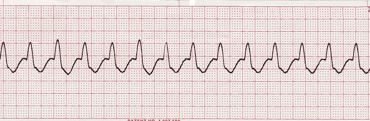 ecg rhythm strip for quiz