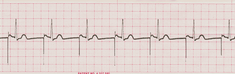 Comprehensive EKG Quiz | Multiple Choice Graded Quiz