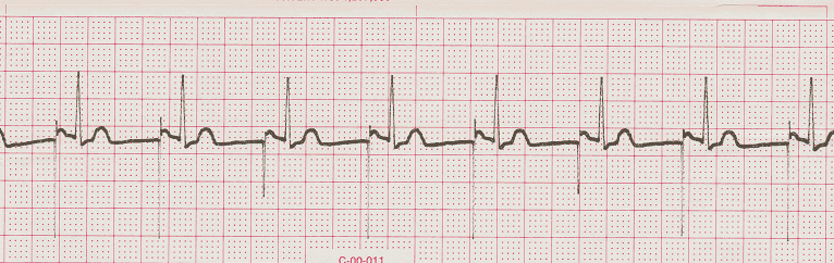 ecg rhythm strip for quiz