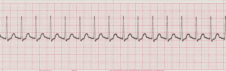 ecg rhythm strip for quiz