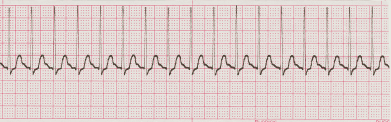 ecg rhythm strip for quiz