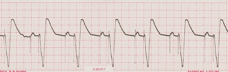 ecg rhythm strip for quiz