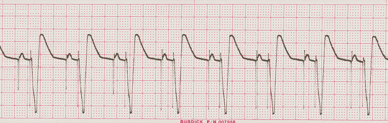 ecg rhythm strip for quiz