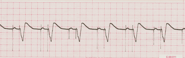 ecg rhythm strip for quiz