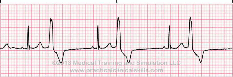 Premature Ventricular Complex - Bigeminy EKG tracing