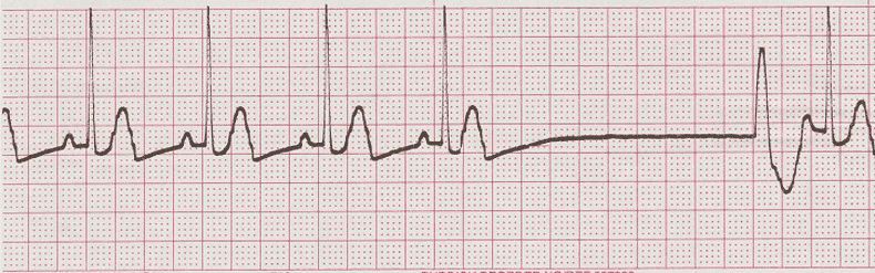 Essential EKGs for Nurses | Multiple Choice Graded Quiz