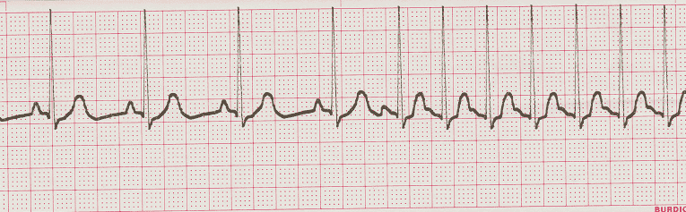 ecg rhythm strip for quiz